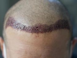 点击看大图 体验后-大麦微针植发丨全国连锁