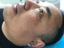 -美丽人生祛斑扁平疣汗管瘤中心