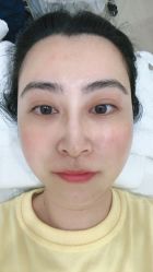体验后-嘉和医学脱毛中心