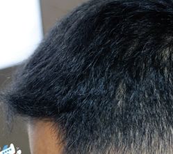 -大麦微针植发丨全国连锁