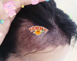 -大麦微针植发全国连锁