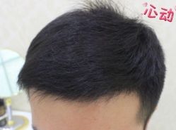 -大麦微针植发丨全国连锁