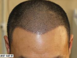 -大麦微针植发丨全国连锁