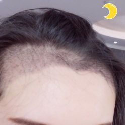 -大麦微针植发丨全国连锁