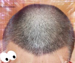 -大麦微针植发全国连锁