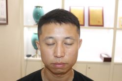 -大麦微针植发丨全国连锁