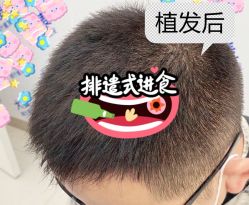 -大麦微针植发全国连锁