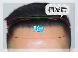 -大麦微针植发全国连锁