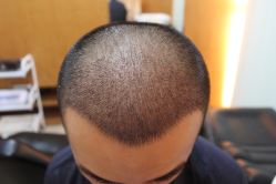 点击看大图 -大麦微针植发丨全国连锁