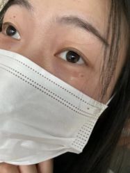 -爱莎扁平疣·汗管瘤·斑痣中心