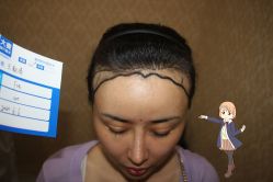 -大麦微针植发丨全国连锁