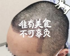 -大麦微针植发全国连锁