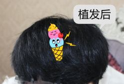 -大麦微针植发全国连锁
