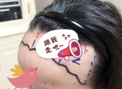 -大麦微针植发全国连锁