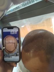 -碧莲盛·不剃发植发