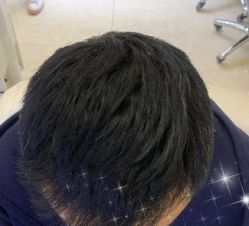 -大麦微针植发全国连锁