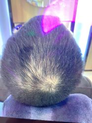 点击看大图 -大麦微针植发丨全国连锁