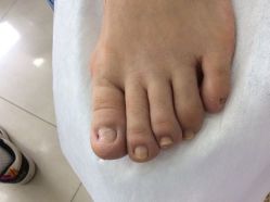 -德哥灰指甲脚气甲沟炎跖疣护理