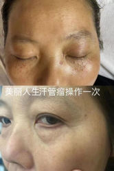 -爱莎扁平疣·汗管瘤·斑痣中心