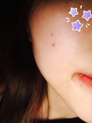 -爱莎扁平疣·汗管瘤·斑痣中心