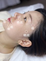 体验前-清疣美疣·痣·斑净肤中心
