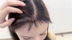 -大麦微针植发丨全国连锁