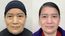 -广州健丽·去眼袋医疗美容机构