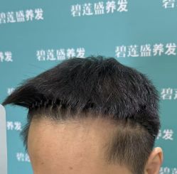-碧莲盛·不剃发植发