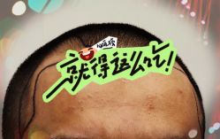 -大麦微针植发全国连锁