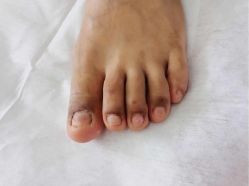 -德哥灰指甲脚气甲沟炎跖疣护理
