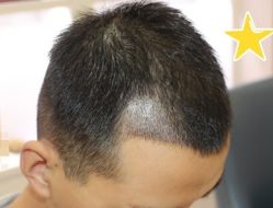 -大麦微针植发丨全国连锁