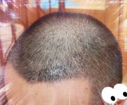 -大麦微针植发全国连锁