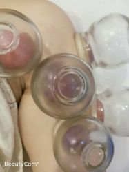 -寇氏拔罐减肥