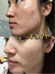 -成都苗方清颜专业祛痘