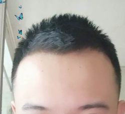 -大麦微针植发丨全国连锁