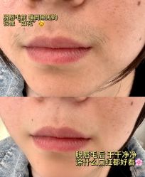 -薇兰专业脱毛连锁机构