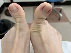 -世龙世家灰指甲鸡眼脚气甲沟炎跖疣护理(通州店)