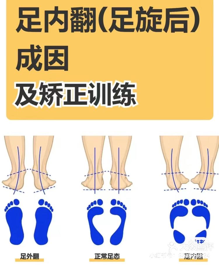 普拉提分享教你改善足内翻