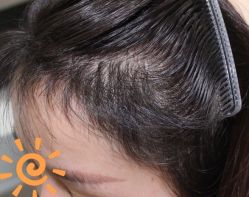 -大麦微针植发丨全国连锁