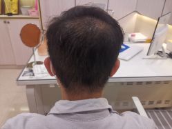 点击看大图 -碧莲盛·不剃发植发