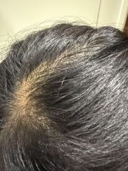 -碧莲盛·不剃发植发