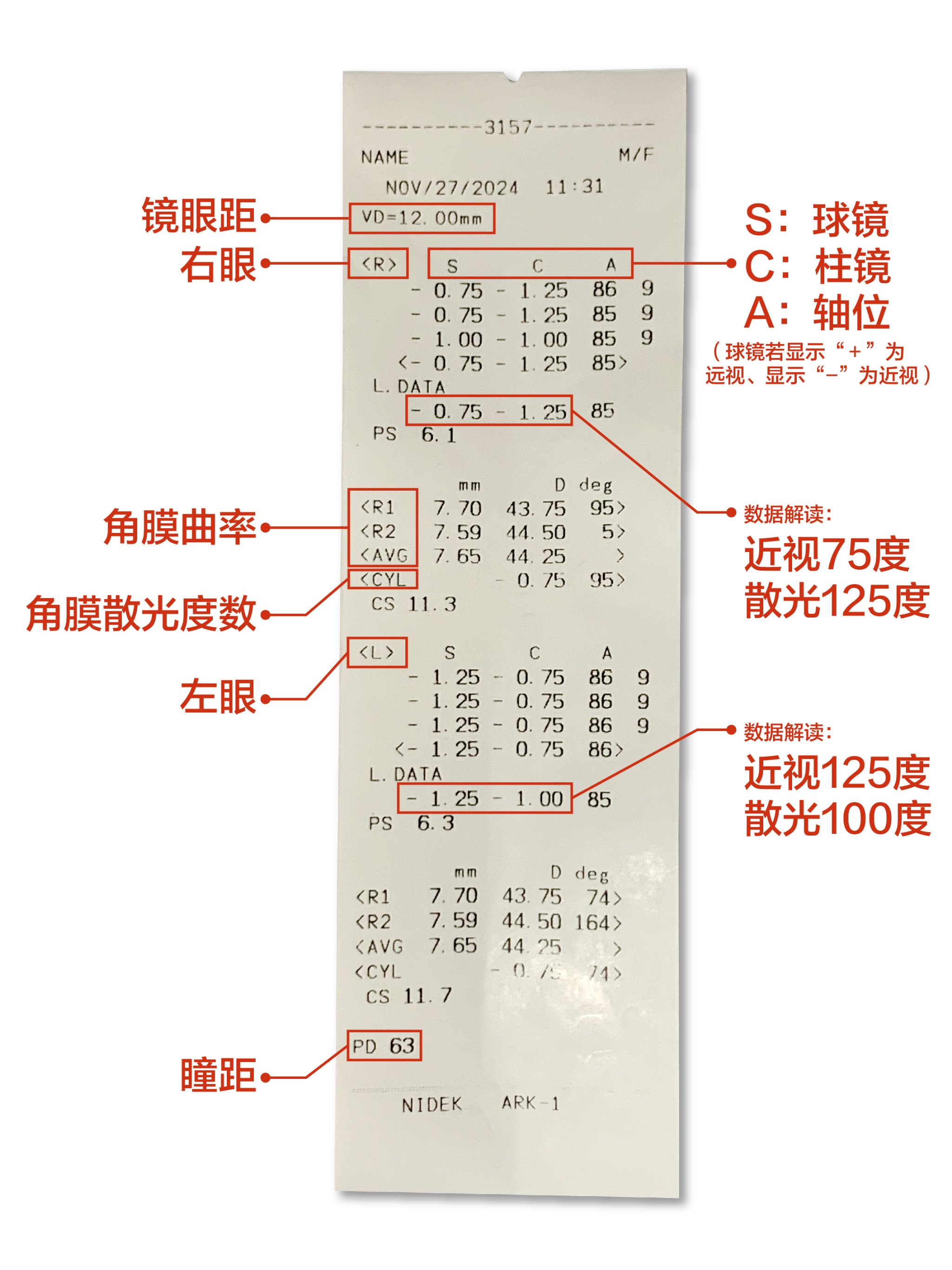 小瞳验光怎么判断结果