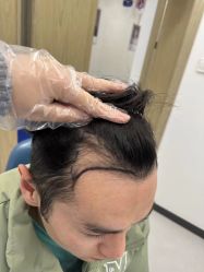 -大麦微针植发全国连锁