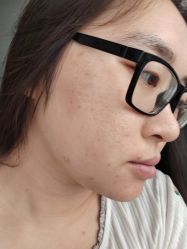 体验后-SKIN79皮肤管理中心