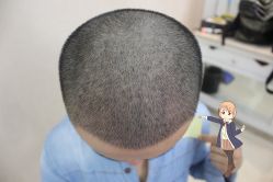 -大麦微针植发丨全国连锁