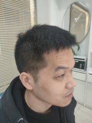 点击看大图 -大麦微针植发丨全国连锁