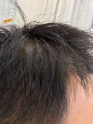 -大麦微针植发丨全国连锁