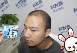 -大麦微针植发丨全国连锁