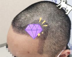 -大麦微针植发全国连锁