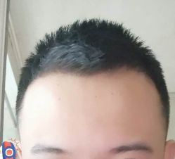 -大麦微针植发丨全国连锁